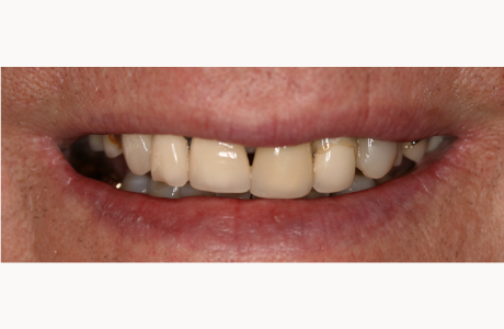 Before: Patient presents with old crowns and an old partial denture.  