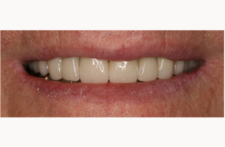 After: Patient treated with new crowns and a new partial denture.  