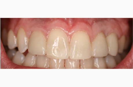 After: Patient treated with braces and three implant-supported crowns.  