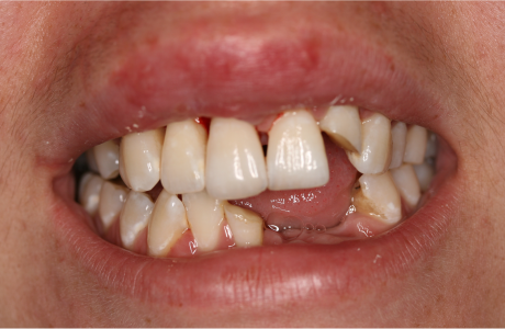 Before: Patient presents with dental trauma.  