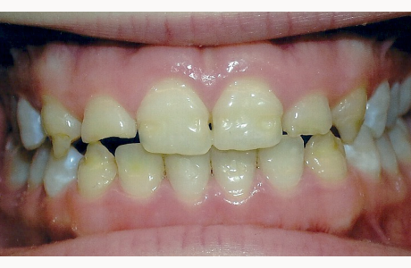 Before: Patient presents with front teeth having a congenital anomaly.  