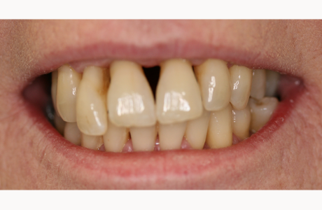Before: Patient presents with upper teeth having minimal bone support.  