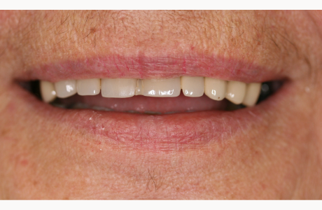 Before: Patient presents with a fractured bridge and failing top teeth.  