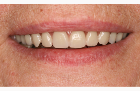 After: Patient treated with a fixed detachable prosthesis supported by five implants.  