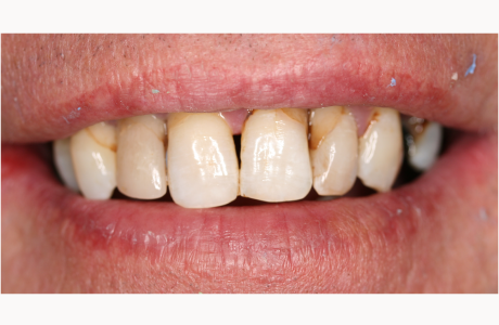 Before: Patient presents with heavily restored teeth having poor bone support.  