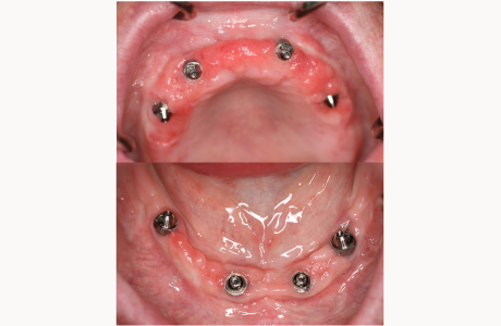 After: Patient had four implants placed in each jaw (All-on-Four) immediately after the extractions.  