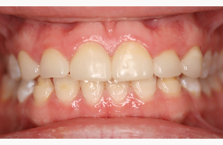 After: Patient treated with bleaching, four crowns, and two veneers.  
