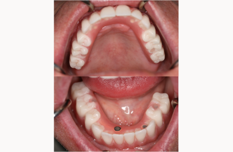 After: Patient had teeth connected to the implants on the same day of implant placement (Same-Day-Teeth).  