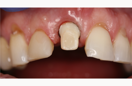 Before: Patient displays an implant post in the right central incisor position.  