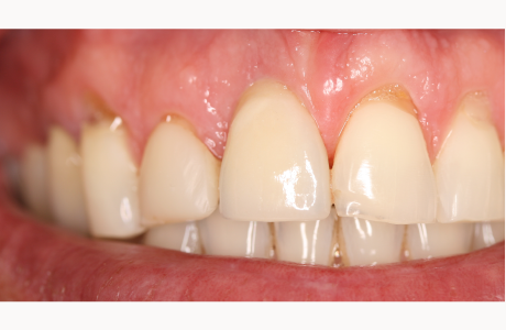 After: Patient displays definitive implant-supported crown.  
