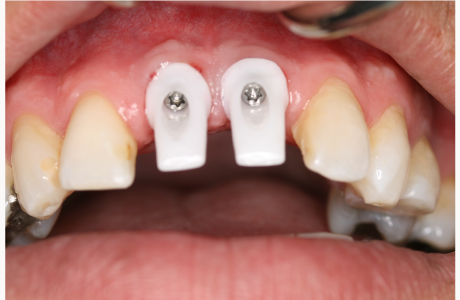 Before: Patient displays two implant posts in the central incisor positions.  