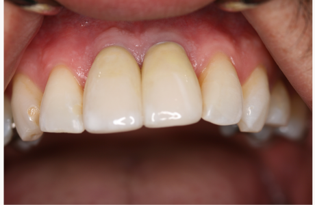 After: Patient displays two implant-supported crowns (retracted lip).  