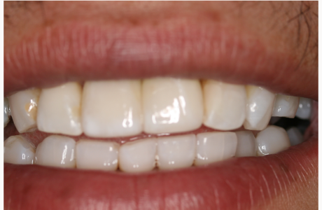 After: Patient displays two implant-supported crowns (normal exposure).  