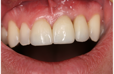 After: Patient treated with orthodontics, bleaching, a tooth-supported crown, an implant-supported crown, and a veneer (retracted lip).  