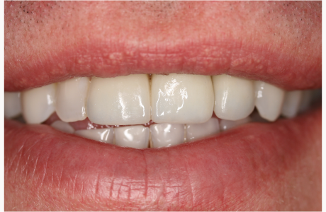 After: Patient treated with orthodontics, bleaching, a tooth-supported crown, an implant-supported crown, and a veneer (normal exposure).  