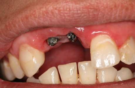 Before: Patient presents with a high lip line and implants placed in an area of deficient bone.  