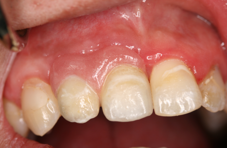 After: Patient treated with splinted crowns having pink porcelain to replace the missing gum tissue.  