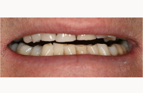 Before: Patient presents with worn teeth.  