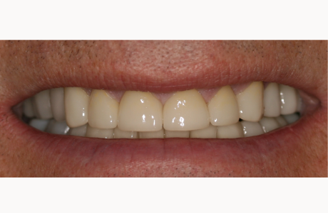 After: Patient treated with nineteen crowns, a tooth-supported bridge, and two direct resin onlays.  
