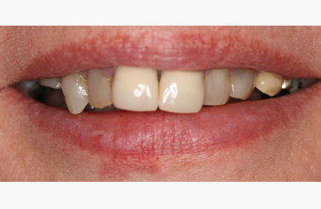Before: Patient presents with fractured teeth, discoloured teeth, and old crowns.  