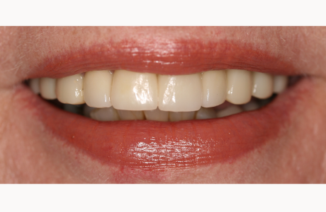 After: Patient treated with seven crowns and one bridge.  