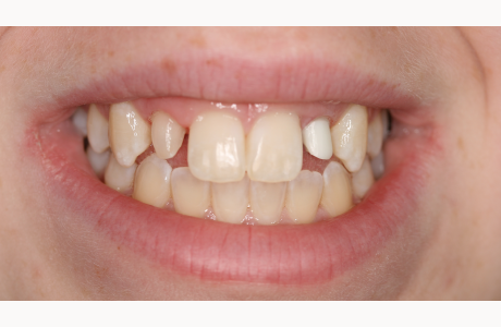 Before: Patient displays a right 'peg' lateral incisor and a left implant post.  