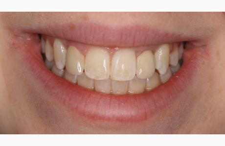 After: Patient treated with a tooth-supported crown and an implant-supported crown.  